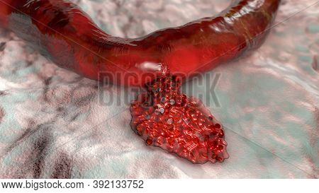 Hemorrhage, Blood Flowing From The Damaged Blood Vessel, 3d Illustration. Hemorrhagic Stroke, Trauma