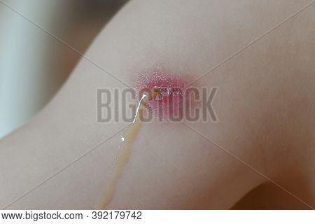 Hand Of A Kid With A Reaction To The Bcg Vaccine