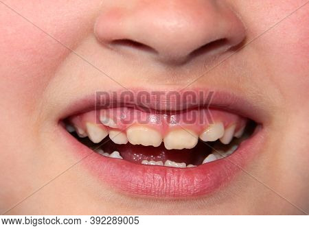 Children's Teeth. The Molar Grows In The Second Row. Anomalies Of Tooth Growth.