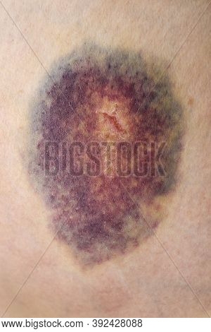 Bruise. Large Bruise. Injection Bruises. Doctor And Patient. Bruised Wound Injury And Bruised Skin