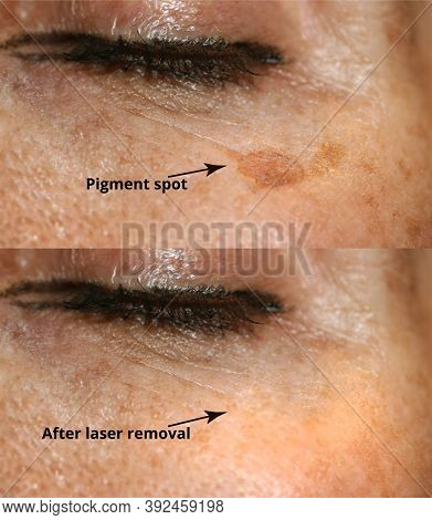 Brown Spot On The Skin Of The Face. Pigmentation On The Skin. After Laser Removal
