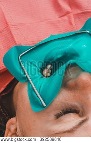 Installation Of A Cofferdam To The Patient, Modern Dental Equipment, Treatment In Sterile Conditions