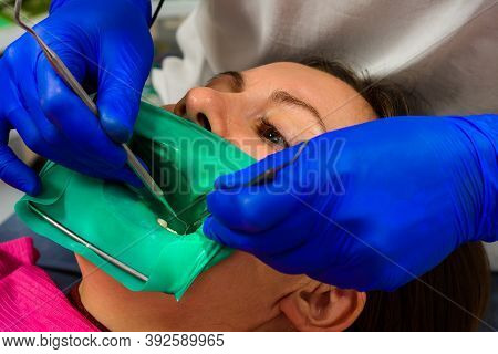 The Dentist Installs A Rubber Dam, Sterile Dental Treatment, Modern Equipment In Dentistry.