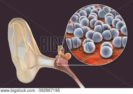 Otitis Media Caused By Bacteria Streptococcus Pneumoniae, An Inflammatory Disease Of The Middle Ear,