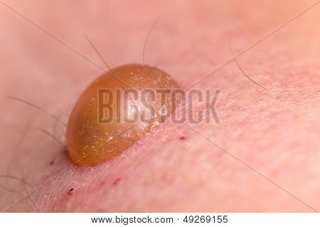 Blister Wound on the Skin, close up