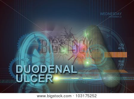 Duodenal Ulcer