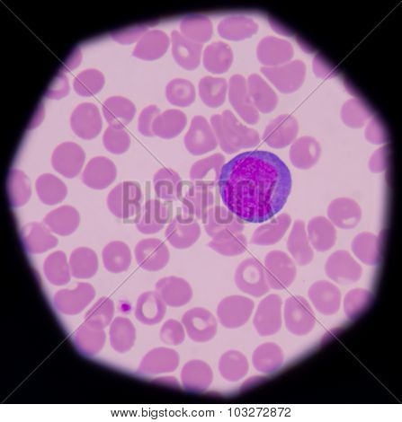 Atypical, Or Reactive, Lymphocytes Are Lymphocytes That, As A Result Of Antigen Stimulation, Have Be
