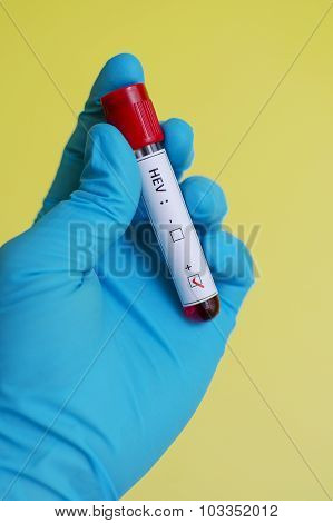 Hepatitis E virus (HEV)
