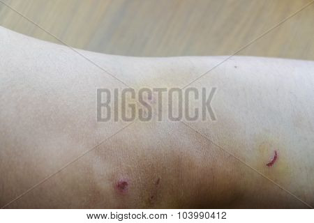 Knee Bruise Contusion