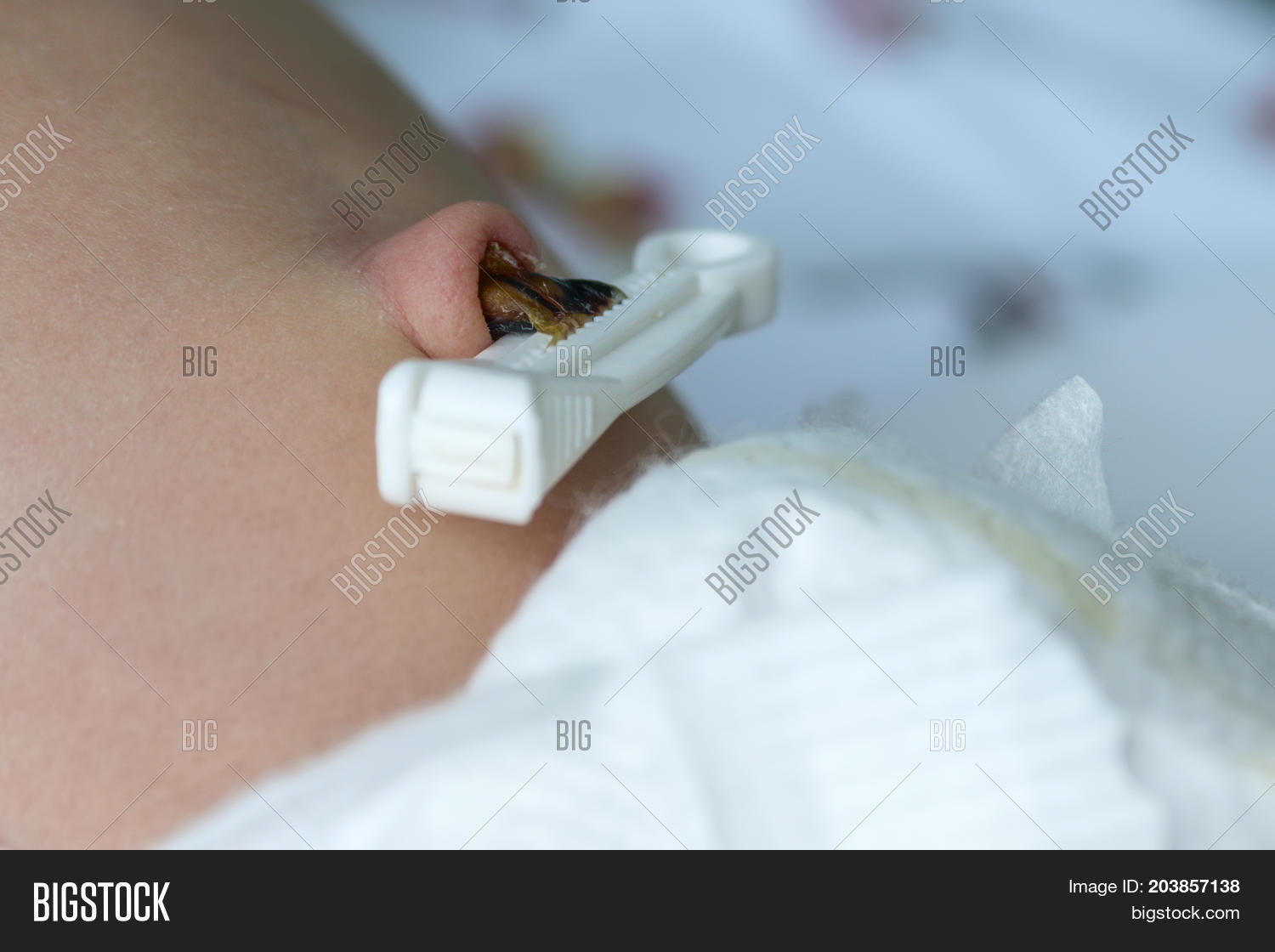 Umbilical Cord Clamp Image & Photo (Free Trial) Bigstock