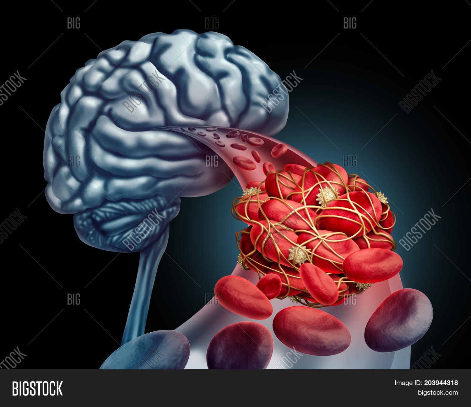 Blood Clot Brain Image & Photo (Free Trial) Bigstock