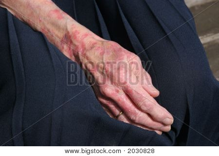 Stan Sceriosis skóry
