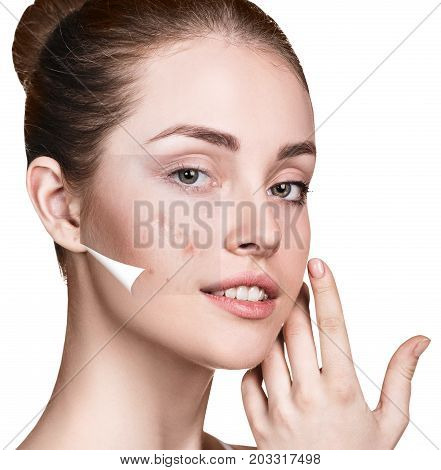 Layer with acne unstick from good healthy skin of young woman.