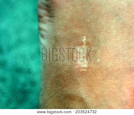 A scar on the skin. Cicatrice on body.