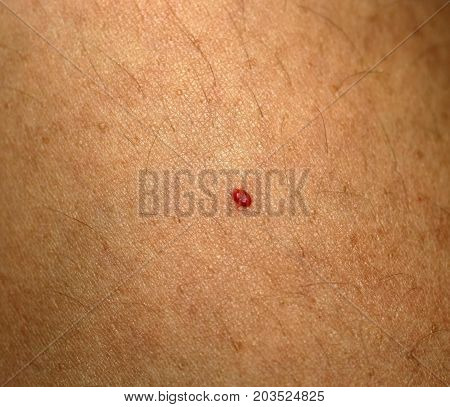 Angioma. Red mole on the body. Birthmark on skin.