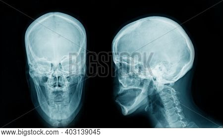X-ray Skull Ap And Lateral View