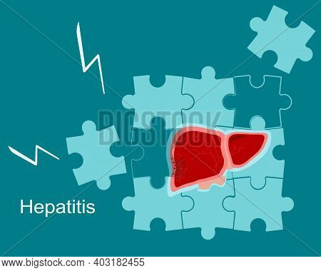Concept Of Hepatitis A,b,c,d, Cirrhosis.fragile And Broken Liver Falls Apart By Puzzles.world Hepati