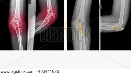 X-ray Elbow Showing Fracture (proximal Ulna Or Olecranon Fracture) Treated By Surgery With Tension B