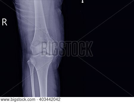 X-ray Knee Join A Female 15 Year Old Showing Large Osteolytic Lesuion Of Medial Aspect Of Right Dist