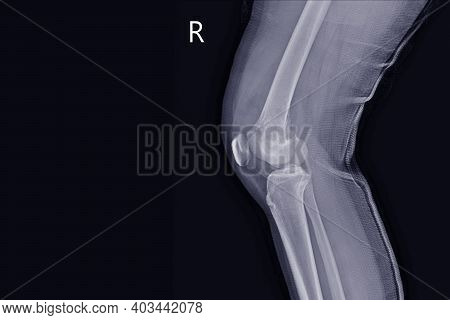 X-ray Knee Join A Female 15 Year Old Showing Large Osteolytic Lesuion Of Medial Aspect Of Right Dist