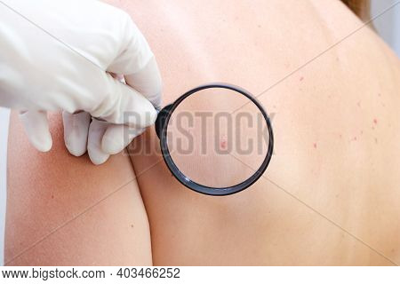 Doctor Examines The Growths On The Skin Of An Adult With A Magnifying Glass, Diagnosis Of Skin Cance