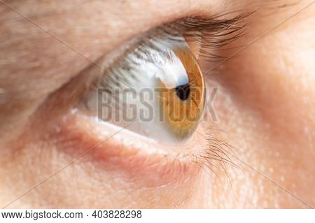 A Man With Glaucoma Bulged His Eyes. Increased Intraocular Pressure, Eye Disease.
