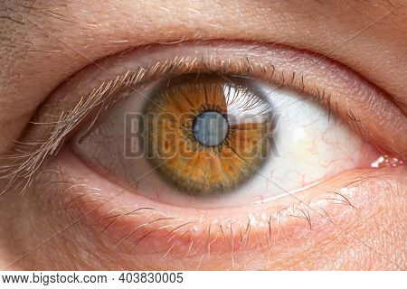 Macro Photos Of The Human Eye - Cataract Clouding Of The Lens, Deterioration Of Vision. Treatment, S
