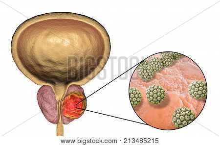 Conceptual image for viral ethiology of prostate cancer. 3D illustration showing Human Papilloma Viruses HPV infecting prostate gland which develops cancerous tumor