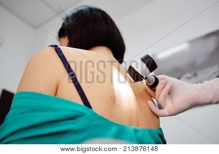 Doctor examining birthmarks and moles patient. examination of birthmarks and moles.the doctor examines the patient's mole