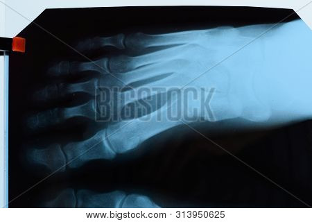 X-ray Of Toes. Foot On X-ray. Bone Research