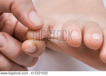A Woman Examines Her Foot With Fungus Or Eczema Between Toes