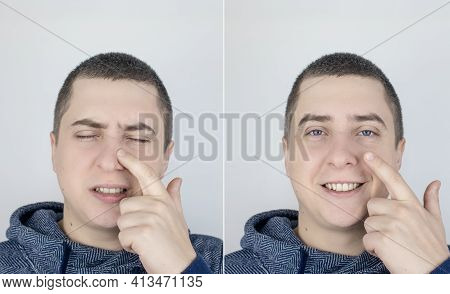 Before And After. On The Left, The Man Indicates Nose Pain, And On The Right, Indicates That Nose No