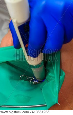 The Dentist Uses Ultraviolet Light When Filling Teeth, Light Blue.