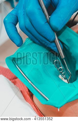 Dental Restoration And Polymerization Of Tooth Composite Materials, The Doctor Conducts Sterile Work