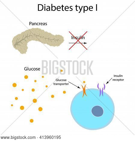Diabetes Type 1. Pancreas, Insulin Receptor, Glucose Transporter, Cell.