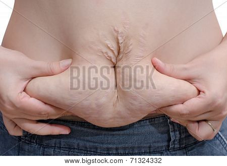 Woman Showing Her Stretch Marks