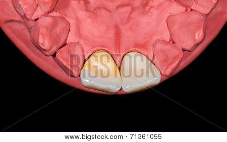 Ceramic Incisor Crown