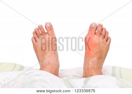 Man with right foot swollen and painful gout inflammation resting on bed
