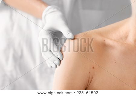 Dermatologist examining birthmark of patient, closeup. Cancer concept