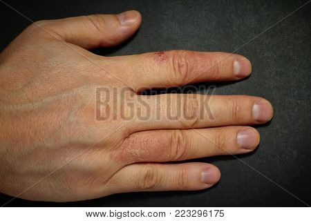 Hand dermatitis. Hand eczema closed on black background