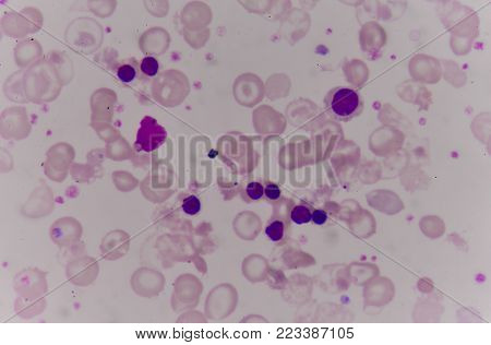 Abnormal red blood cells in Blood smear Thalassemia patient.