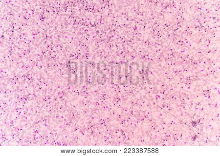 Abnormal red blood cells in Blood smear Thalassemia patient.
