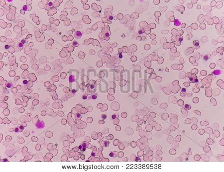 Blood Smear Thalassemia Patient.