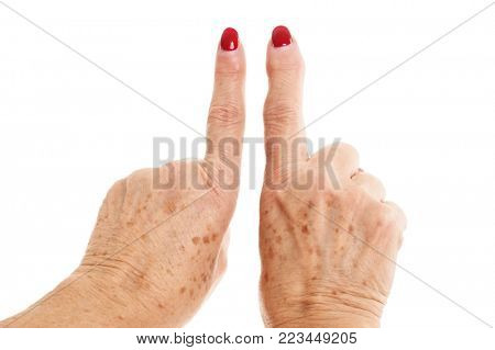 Picture Showing Old Woman's Hands Deformed From Rheumatoid Arthritis