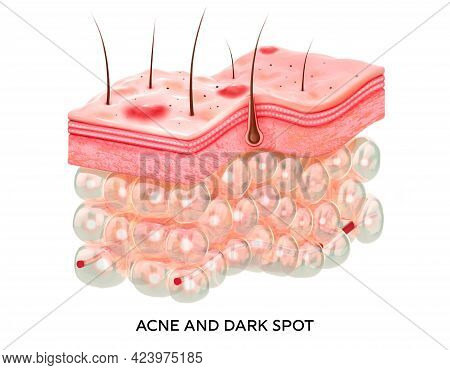 Skin With Acne. 3d Illustration Of The Structure Of The Skin Layers Microstructure.medical And Educa