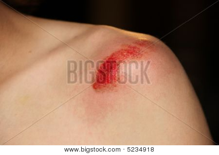 Blutungen Schulterverletzung