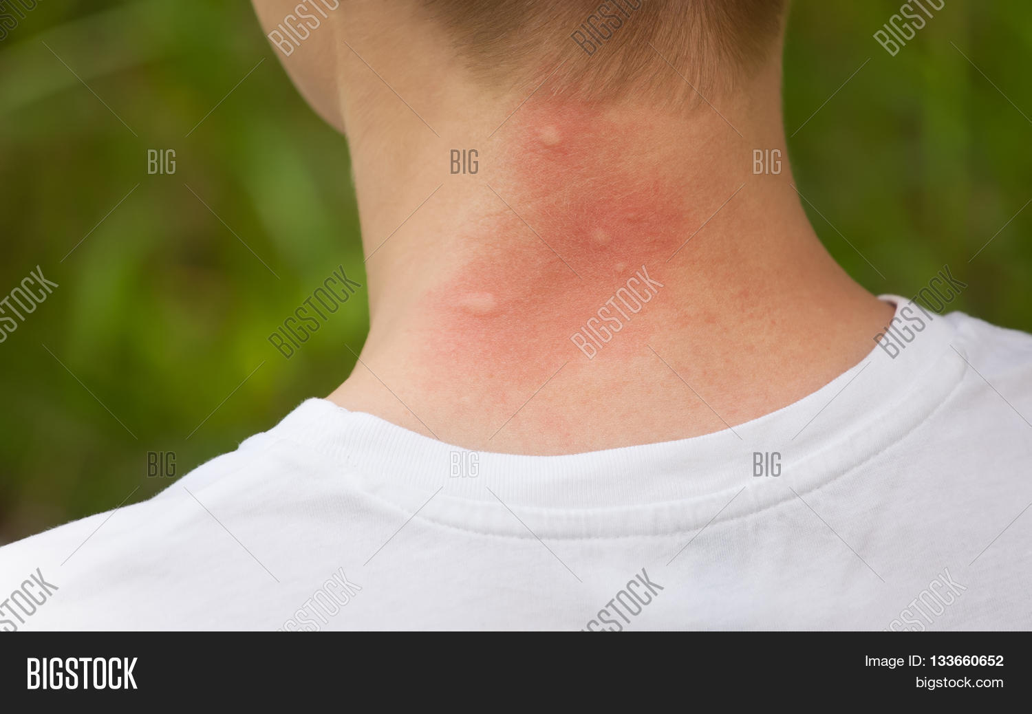 Mosquito Bites On Neck Image & Photo (Free Trial) Bigstock