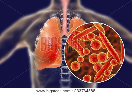 Mycoplasma Pneumoniae Bacteria In Human Lungs, 3d Illustration. Medical Concept For Mycoplasma Pneum