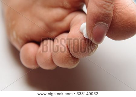 Man Applying Cream For Athletes Foot Treatment