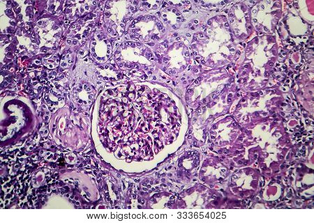 Chronic Nephritis, Light Micrograph, Photo Under Microscope